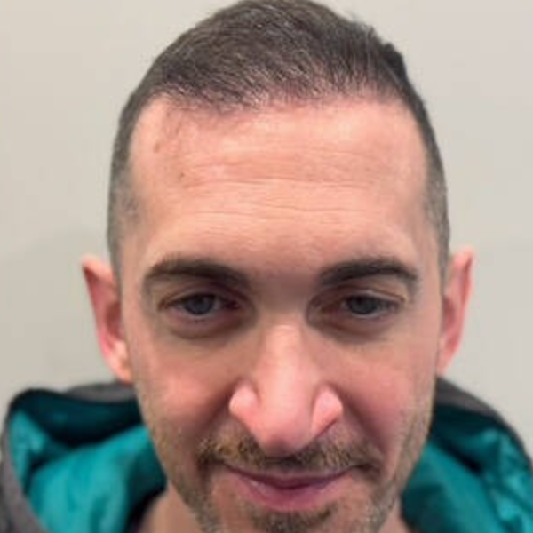 Patient after hair restoration